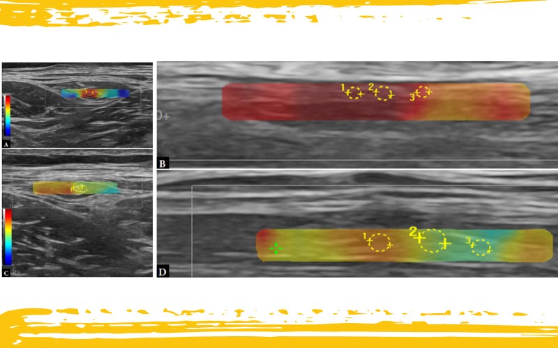 Meralgia parestesica tempo formacion ecografia 4.jpg